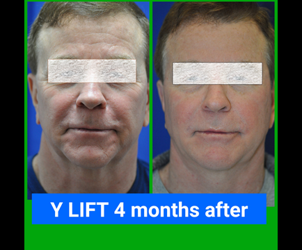 The man's complexion in the before photo reflects the signs of aging, but in the after image, the Y-Lift treatment has revitalized his facial features.