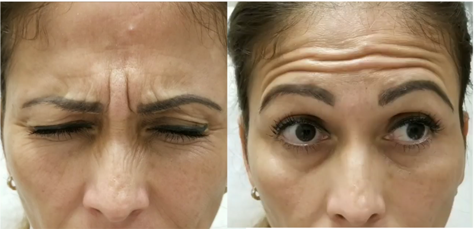 Before and after treatment of woman's forehead wrinkles.
