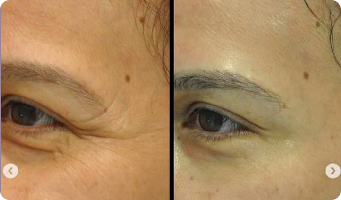 Woman's face with wrinkles transformed into a smooth complexion.