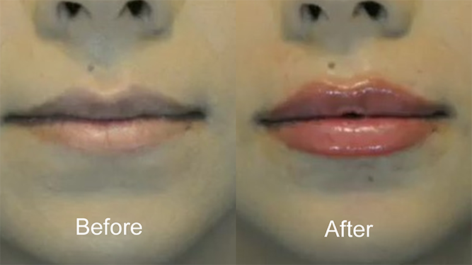 Before and after lip lift procedure. Noticeable improvement in lip shape and volume.