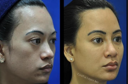 See the remarkable difference in a woman's appearance before and after her face lift surgery.
