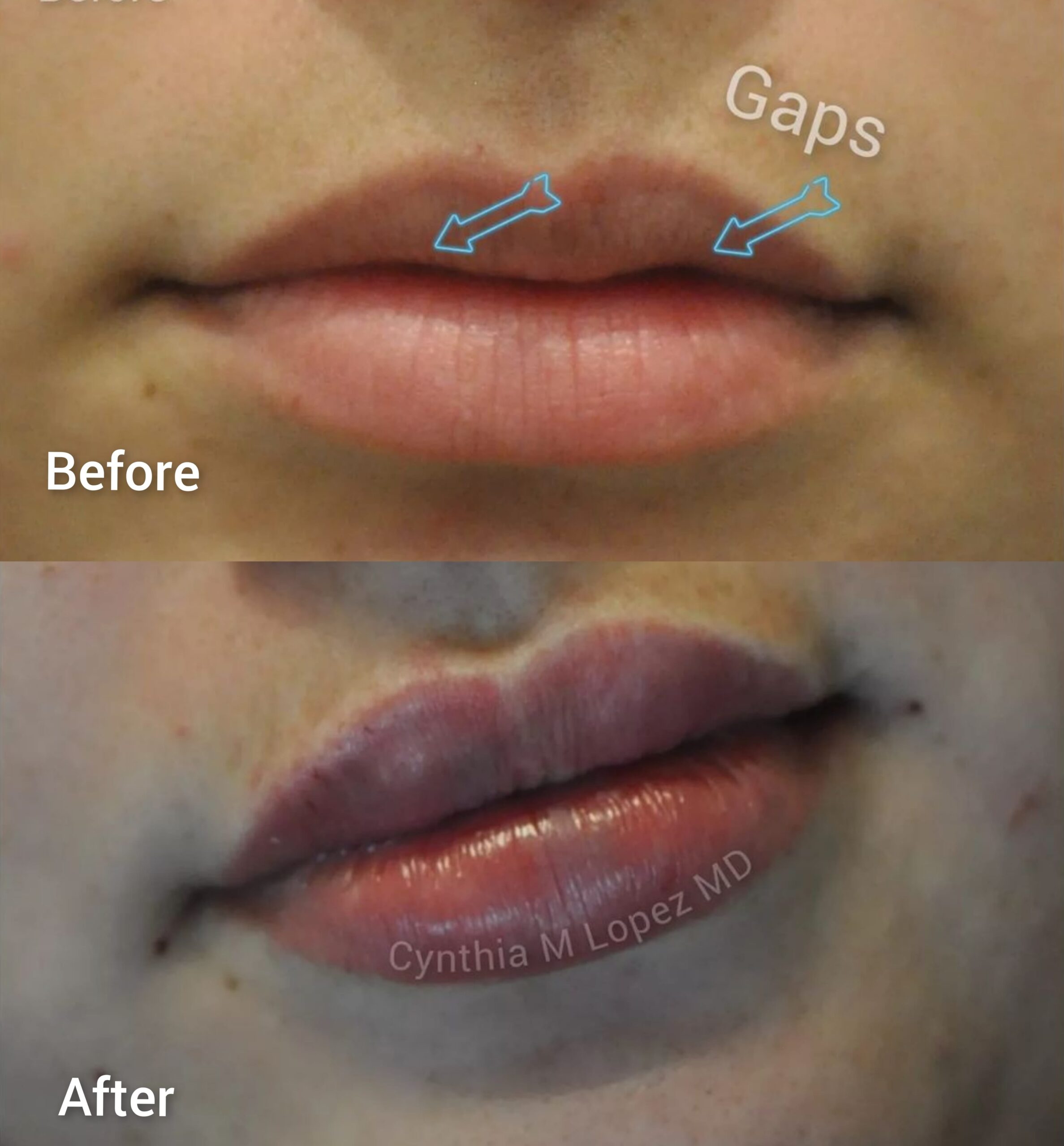 The before top image shows a young female lips in her 30’s. Her top lip is moderately M shaped. The middle portion is beaky-looking. The sides have gaps and folds towards the teeth. She wants to have more lip show on the sides and fill in the gaps. The after right image shows naturally plumped-up lips after injection of hyaluronic acid filler. Her side lips now fuller and gaps gone, her cupid’s bow more defined and perky with a natural-looking pout