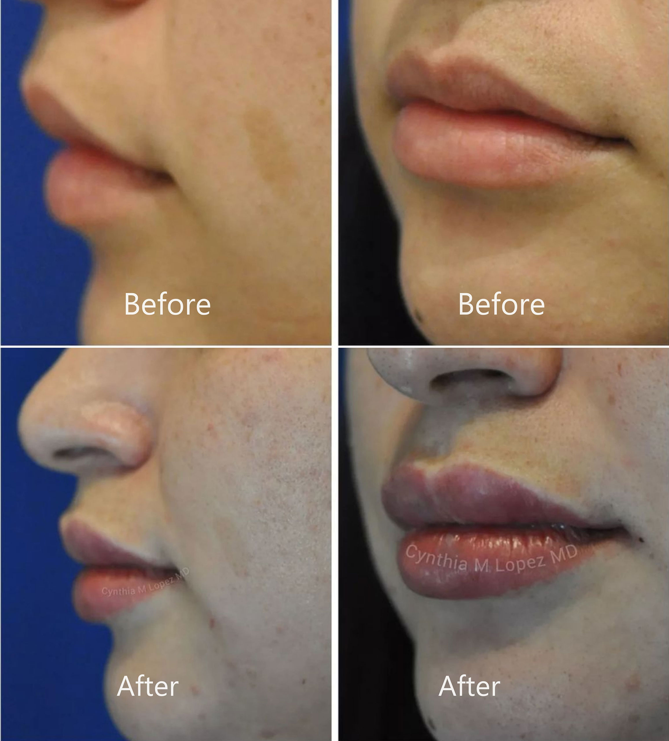The before left images show a young female lips in her 30’s. Her top lip is moderately M shaped. The middle portion is beaky-looking. The sides have gaps and folds towards the teeth. She wants to have more lip show on the sides and fill in the gaps. The after right images show naturally plumped-up lips after injection of hyaluronic acid filler. Her side lips now fuller and gaps gone, her cupid’s bow more defined and perky with a natural-looking pout.