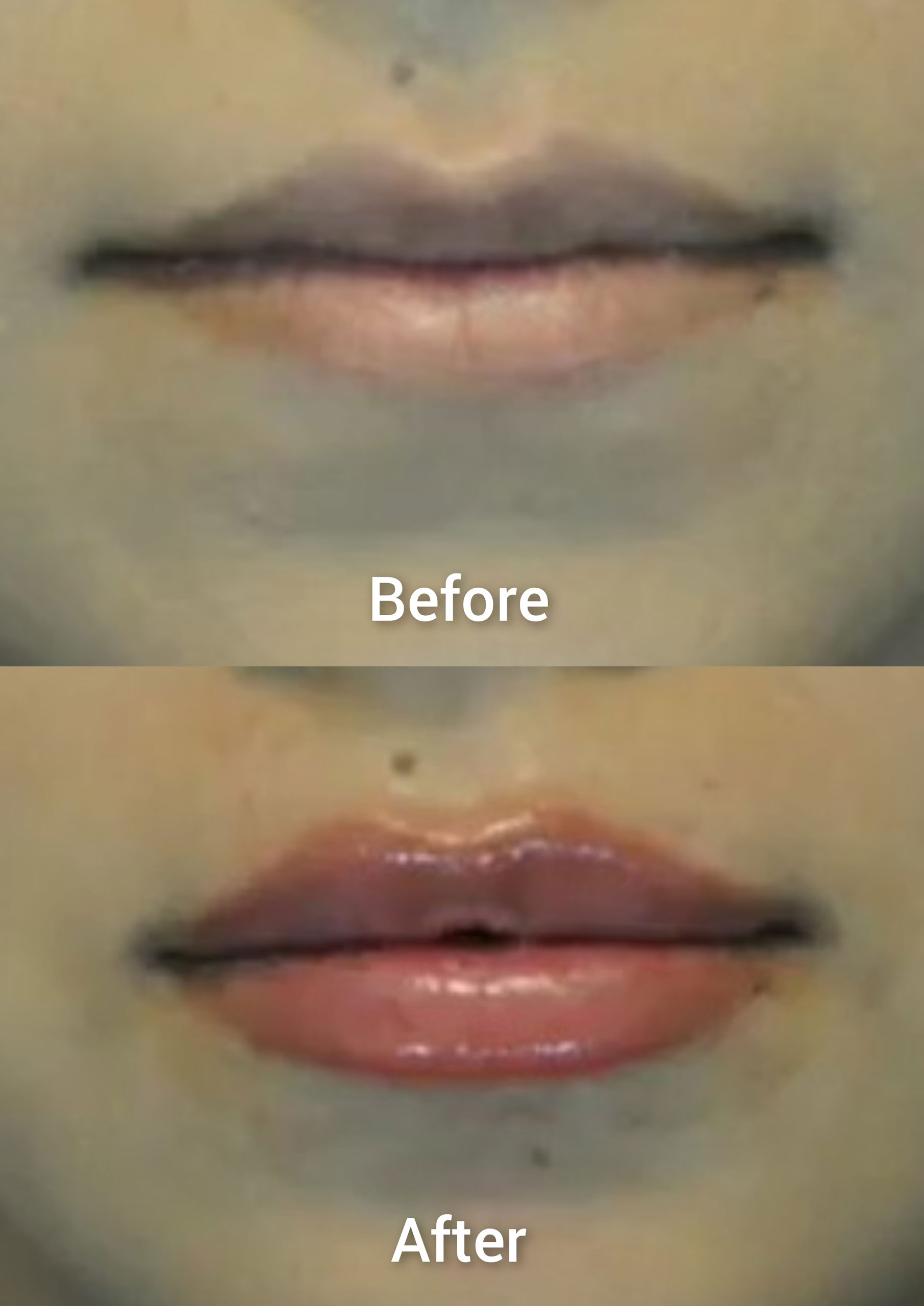 The before top image shows a young female lips in her 20’s. Her top lip is slightly M shaped. The middle portion is touching the bottom lip but the sides has some space. She thought her lips are slightly wider and she wants it to be a little rounder. She also wants to have a key hole. The after bottom image shows naturally plumped-up lips after injection of hyaluronic acid filler. Her lips now looks more rounded, her cupid’s bow more defined and perky with a natural- looking pout.