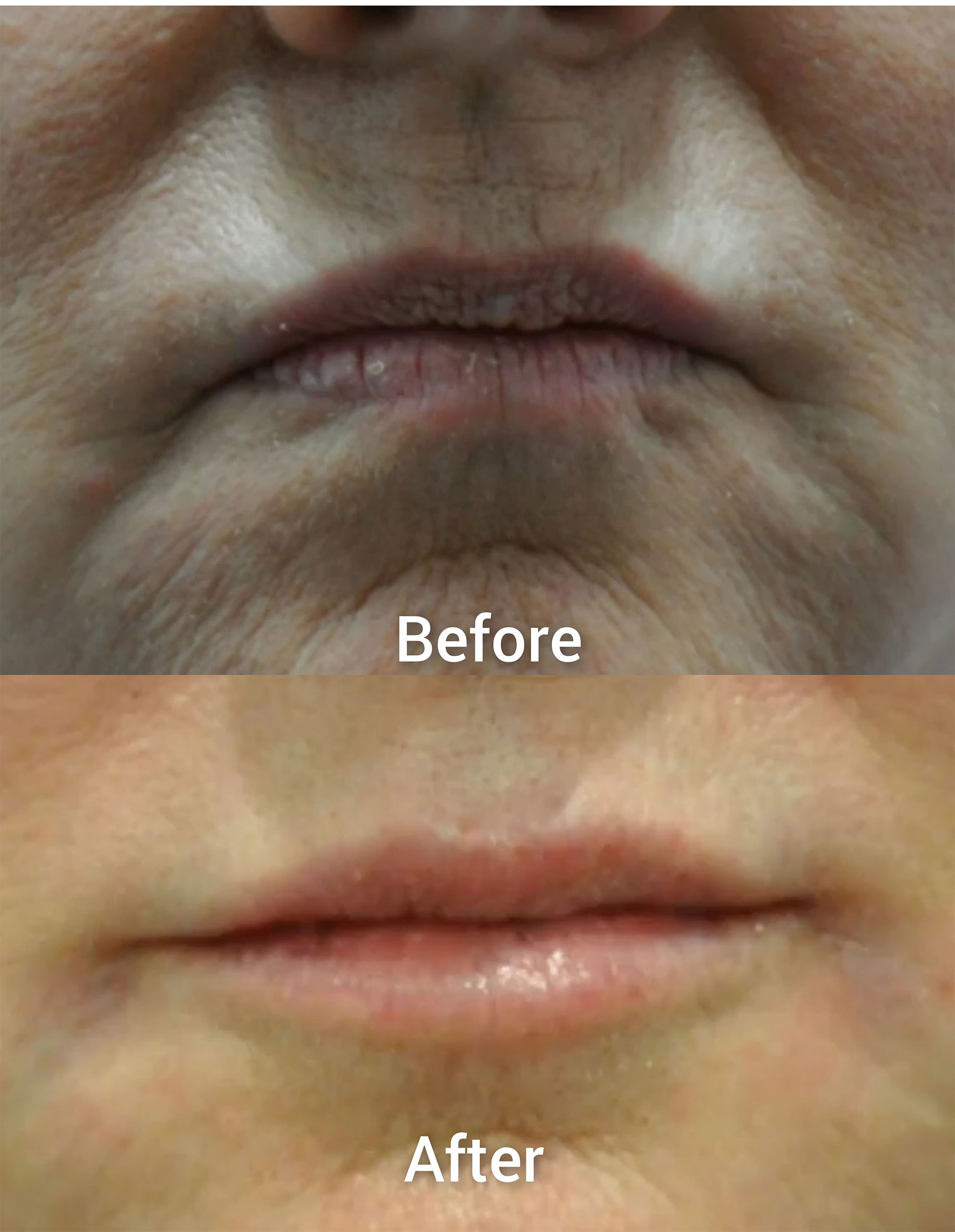 Woman in her 60’s. Her before top image shows a downturned mouth that makes her look mad and unapproachable in what many people refer to as “resting bitch face”. The after bottom image now shows a horizontalized mouth, slightly plumper top and bottom lips with a slightly impish smile at rest. This was achieved with lip fillers and Botox to the muscles around her mouth. She is beyond happy with her result.