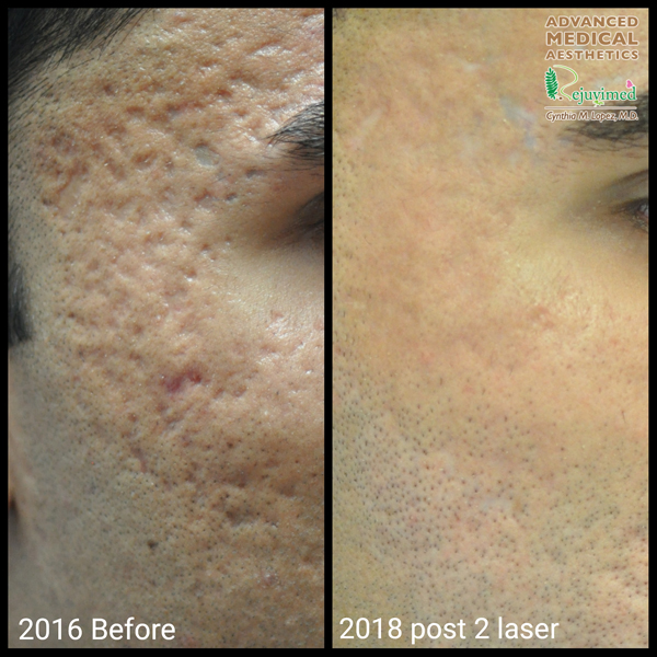 A comparison of a man's skin condition is shown in two photos. The first photo displays acne, while the second photo shows clear skin.