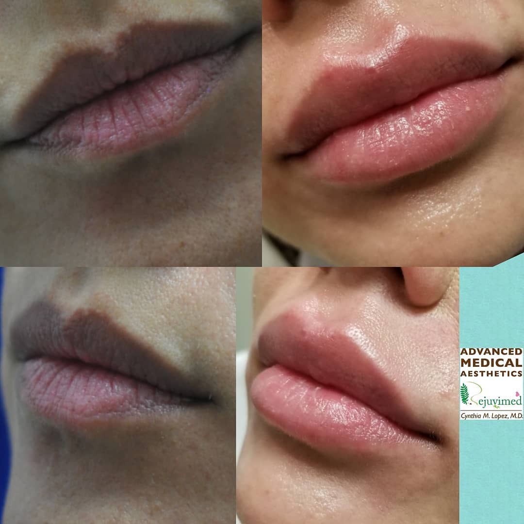 The before left images show a young female lips in her 30’s. Her cupid’s bow is starting to blur and her lower lip is showing signs of volume loss. The after right images show naturally plumped-up lips after injection of hyaluronic acid filler. Her cupid’s bow becomes more defined and perky with a natural-looking pout.