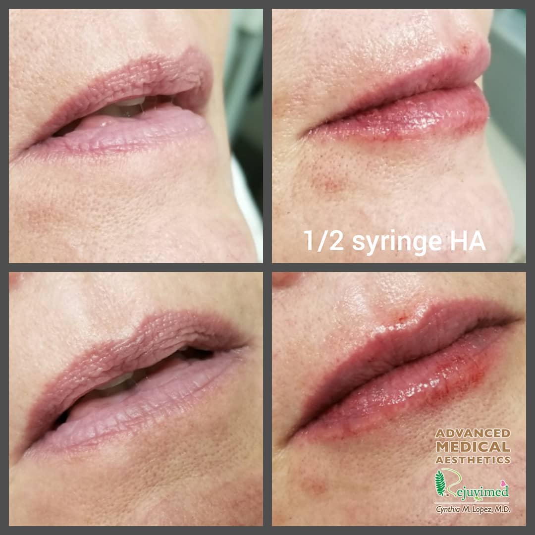 The before left images show female’s lips in her 50’s, that have lost volume and definition. The lower lip has moved inwards towards the teeth. The after right images show naturally plumped-up lips after injection of hyaluronic acid filler.Her cupid’s bow becomes more defined and perky.