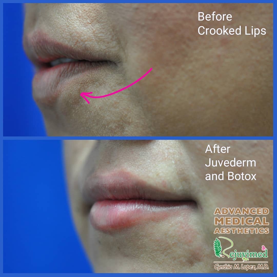 Woman in her 20’s. In the before top image, her left bottom lip is crooked due to traumatic scarring. The after bottom image shows evening out of the crooked lip after lip filler and Botox injection.