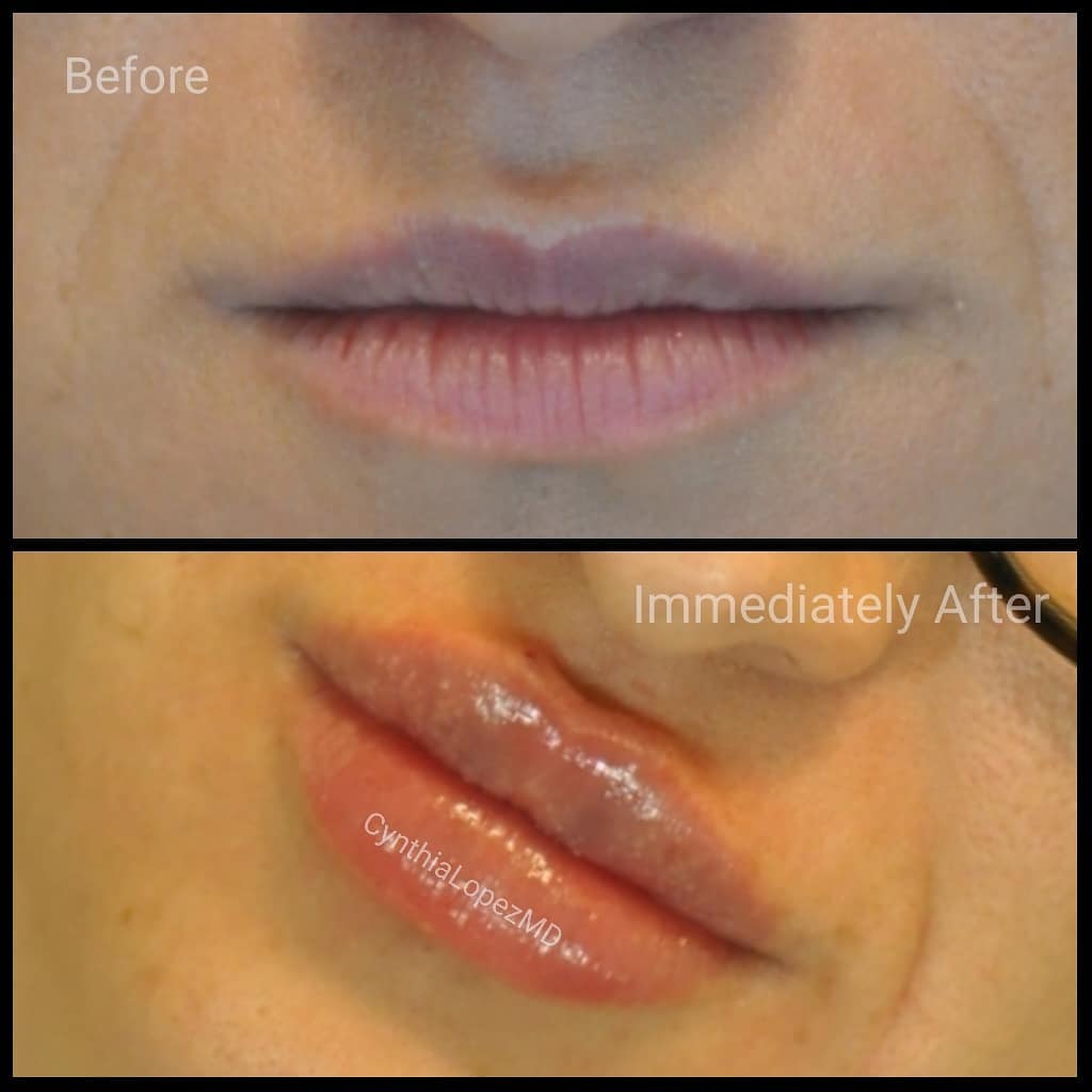 Woman in her 20’s. In the before top image, her top and bottom lips are thinning out even at a younger age. The deflation led to wrinkling of lip skin. The after bottom image shows fuller lips and her lip wrinkles are now gone after lip filler injection.