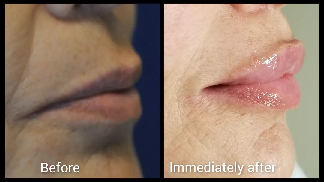 Woman in her 40’s. She thought her lips are thinning, widening and corners going downwards, shown in the before left image. The after right image now shows more rounded mouth, fuller lips and horizontalized corners.