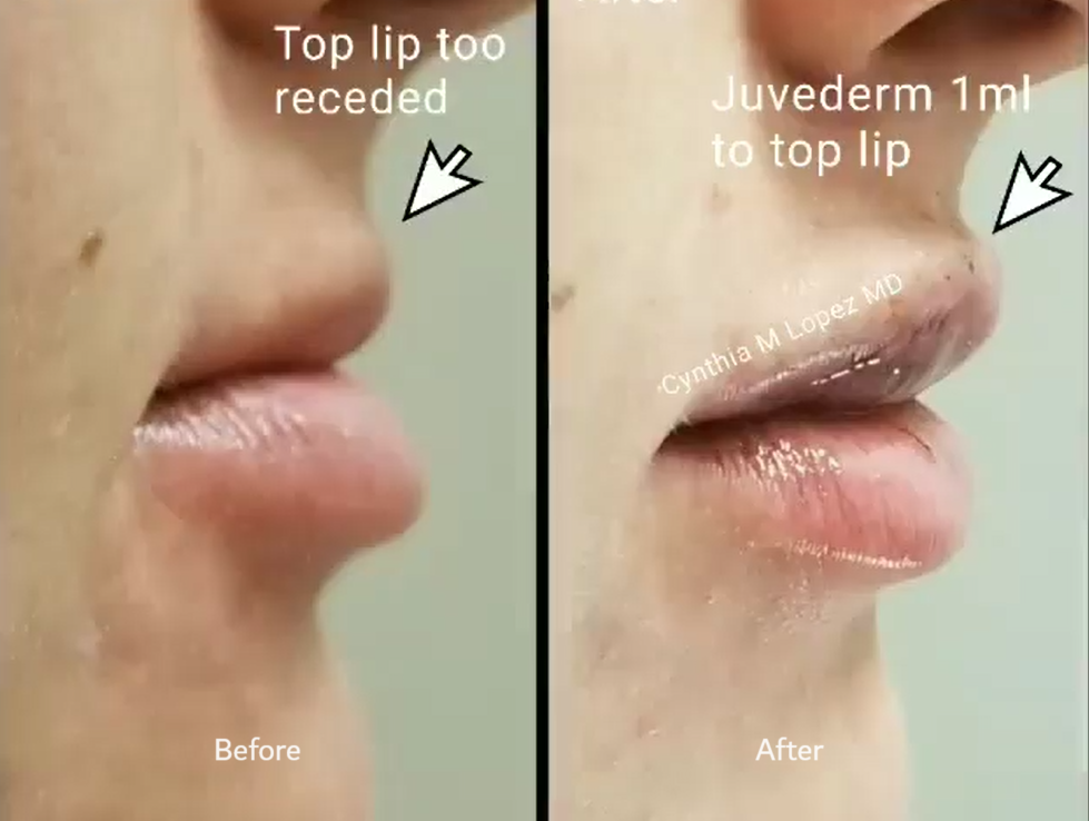 The before left image shows a young female lips in her 30’s. Her top lip is receded because of an underbite. The after right image shows her top lip now fuller and aligned with her lower lip after injection of hyaluronic acid filler.